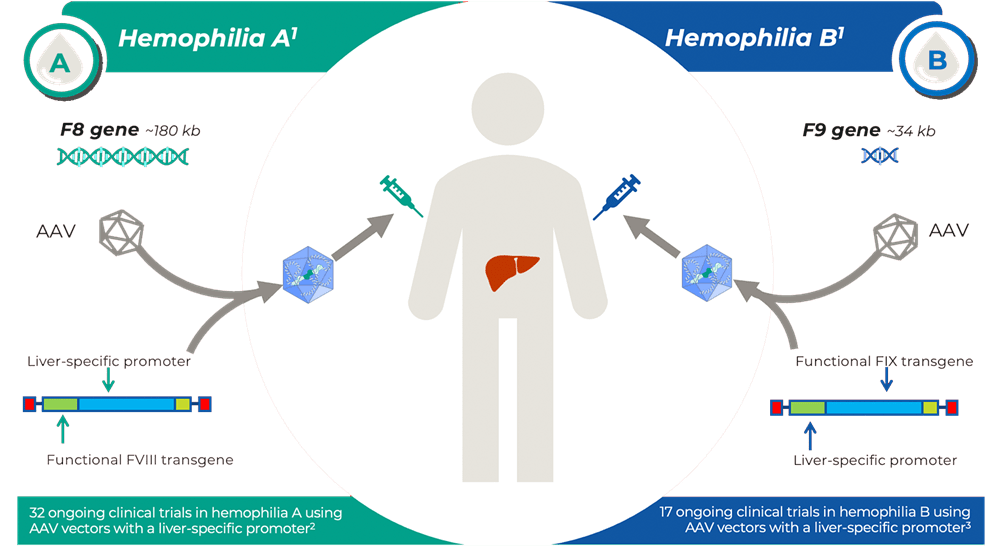 Gene therapy approaches are being utilized for both hemophilia A and B