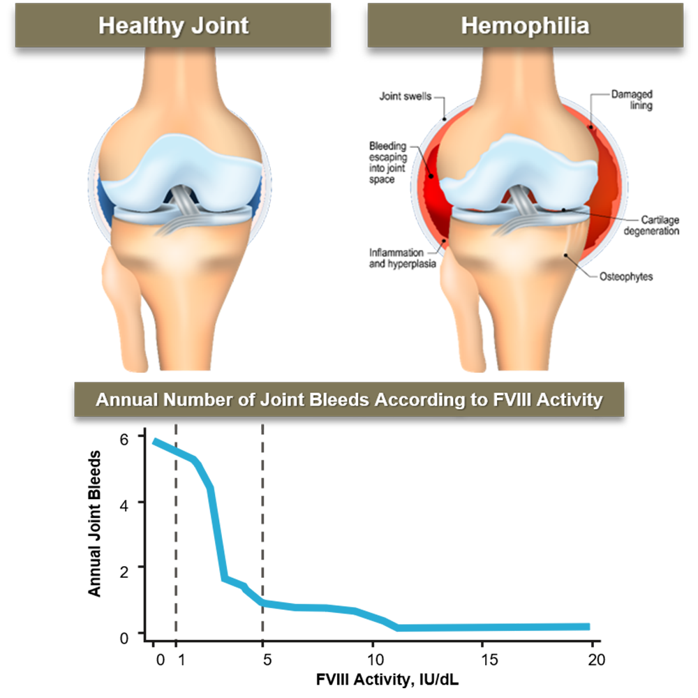 Images of healthy joints and then joints that are affected by having Hemophilia, and a chart that shows the annual number of joint bleeds adcording to FVIII activity 